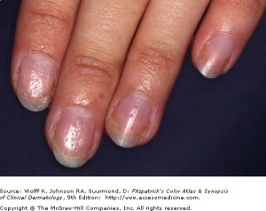 nail-psoriasis